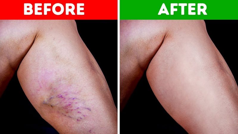 Natural Ways Of Eradicating Varicose Veins