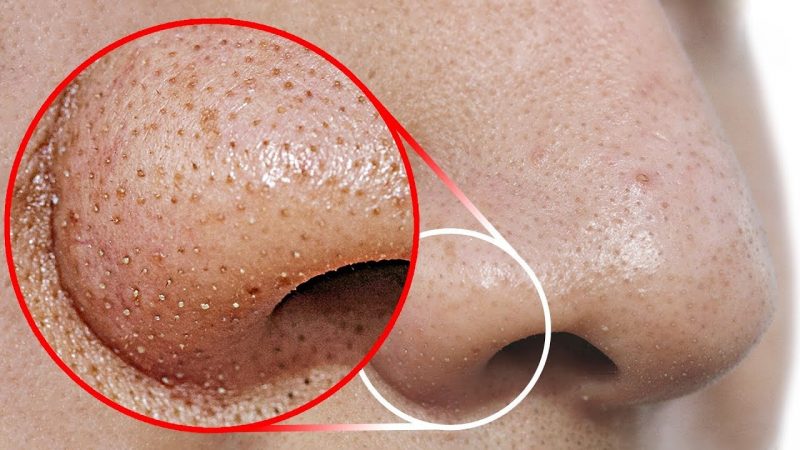 How To Get Rid Of Blackheads From Your Nose